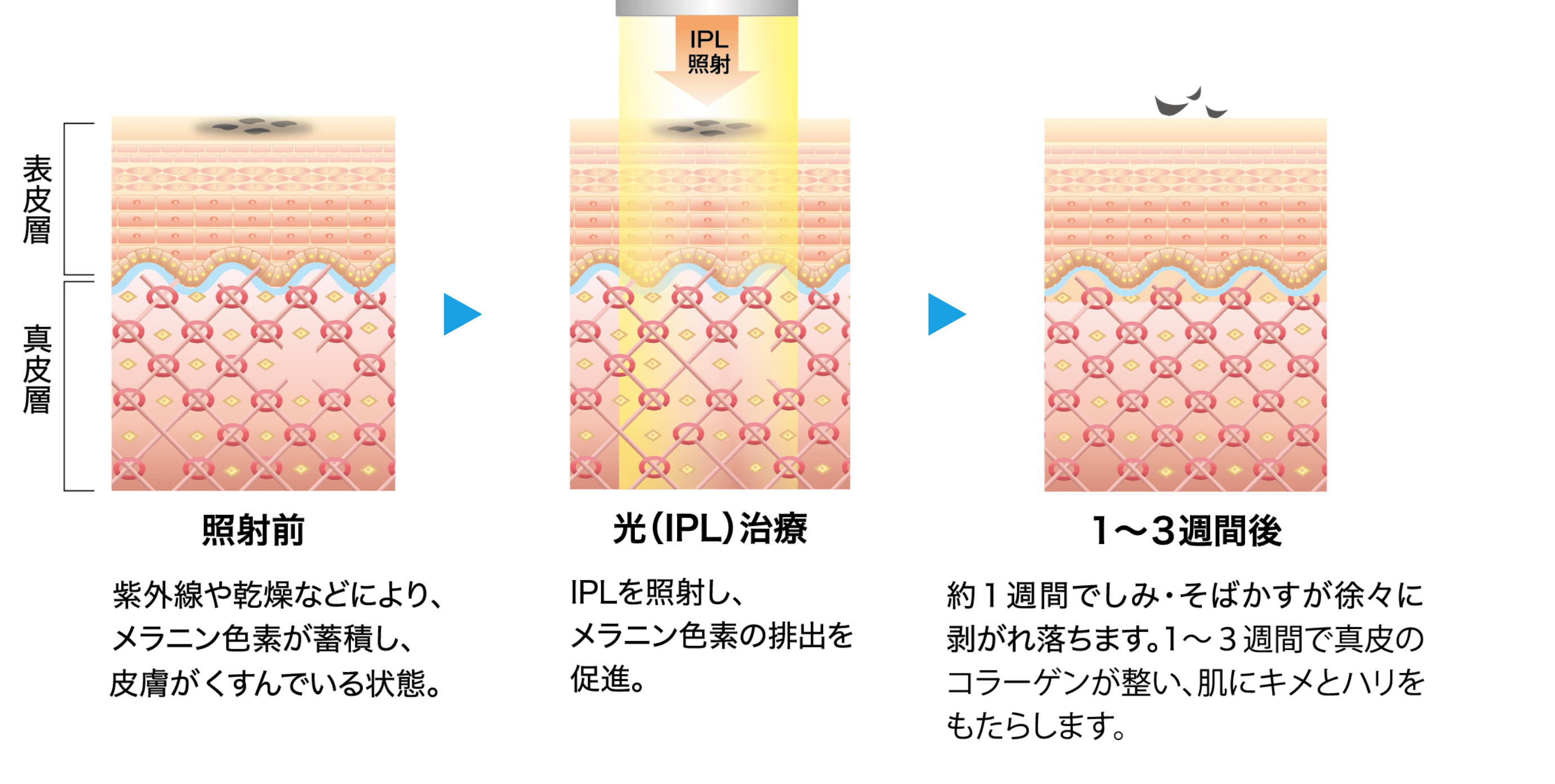 IPLのメカニズム