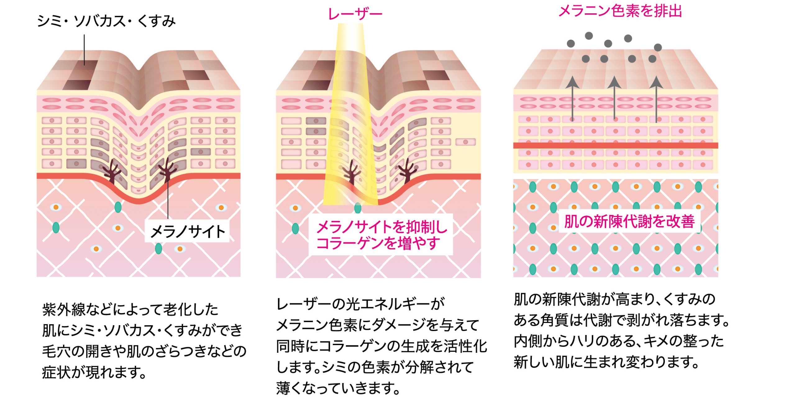 IPLのメカニズム