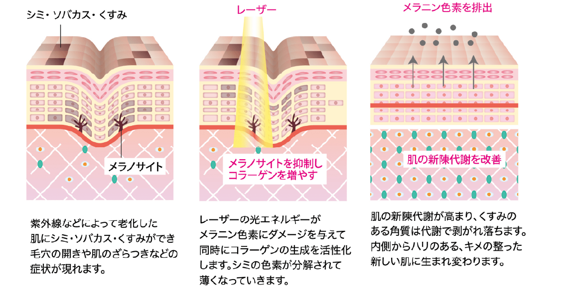 レーザートーニングplusの仕組み