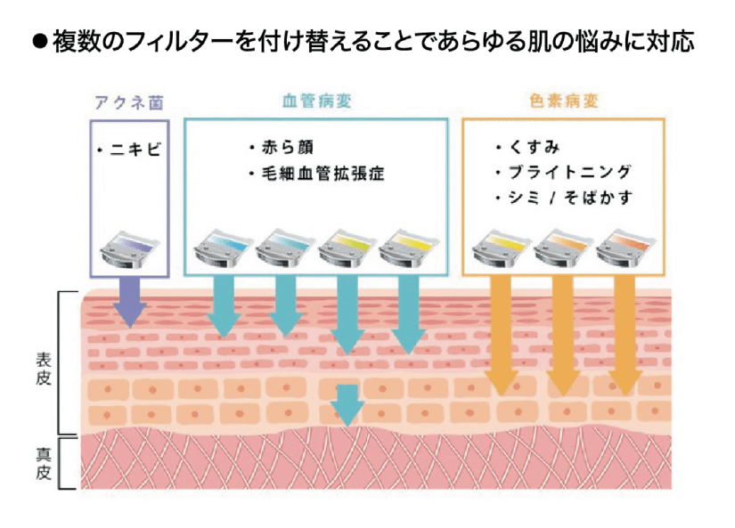 IPLフォトフェイシャルplusの仕組み